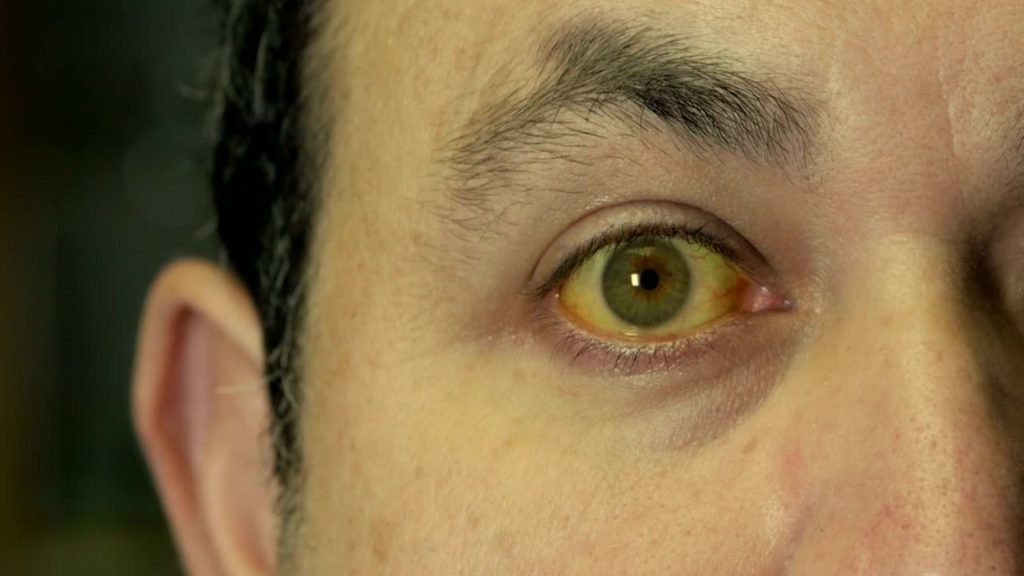 The man's skin and eyes' color show that he suffers from jaundice