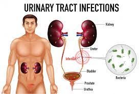 Urinary tract infection